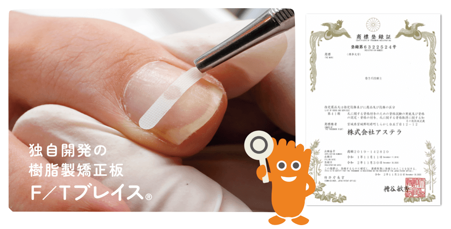 巻き爪矯正院　F/Tブレイスの紹介画像